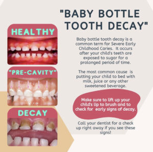 photo of toddler with tooth decay early childhood caries baby bottle caries