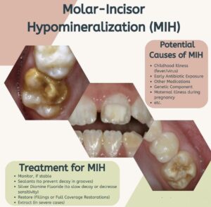 Potential causes of MIH
Treatment for MIH
Molar Incisor Hypomineralization
Developmental Dental Defect
Developmental Defect of Enamel